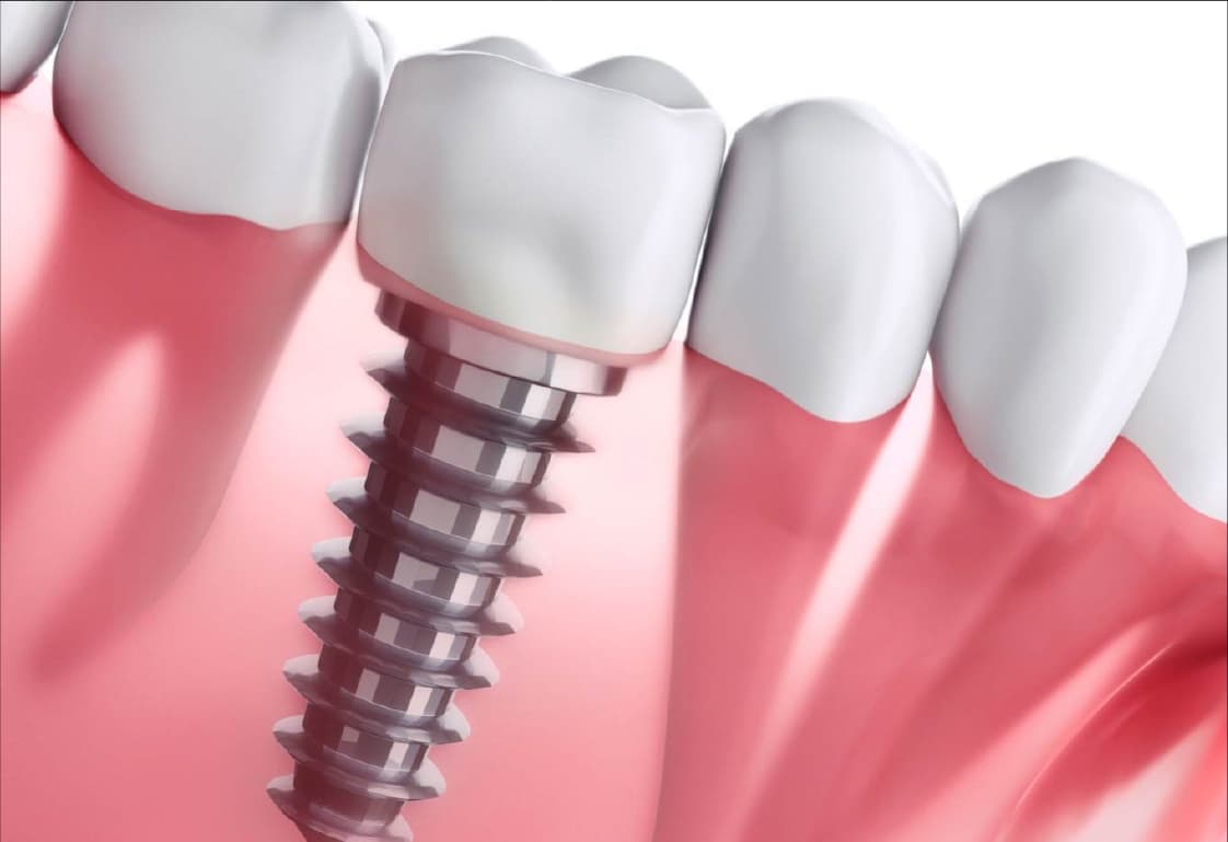 Implantes, Próteses & Restauração