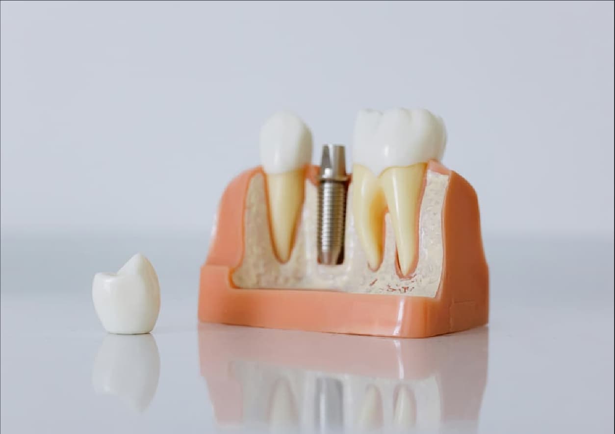 Implante dentário em Odivelas: preço, como funciona e quando é necessário